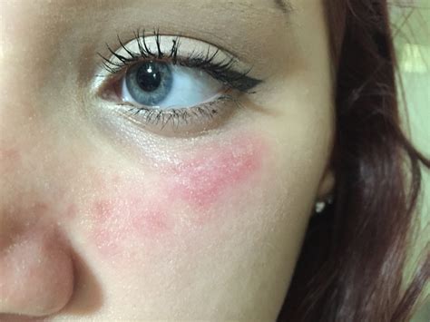 eye makeup allergy rash